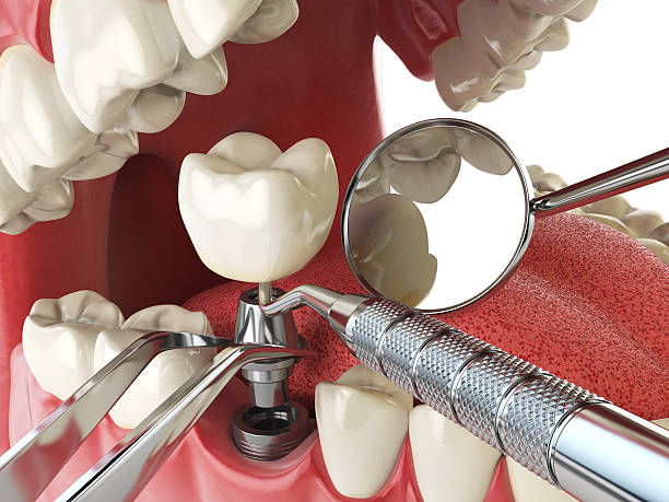 Best Emergency Tooth Extraction in Shadybrook, TX